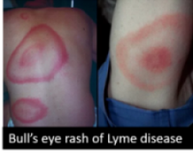 Bull's eye Lyme Disease Rash